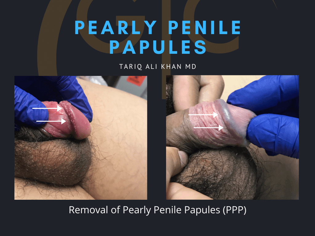 Gentle Care Laser Tustin & Long Beach Before and After picture - pearly penile papules